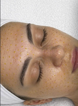 BioRePeel treatment